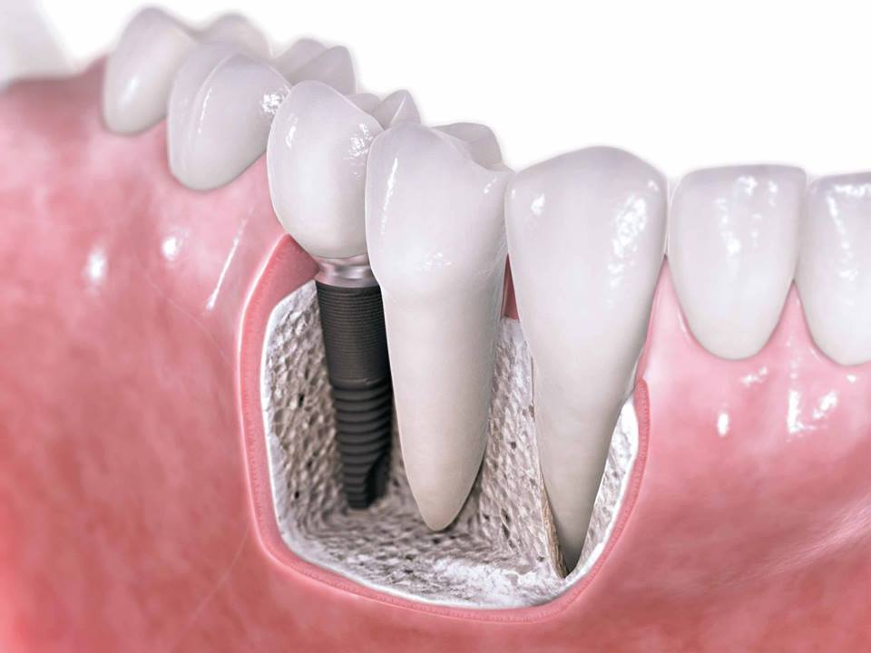 implanty zębowe bydgoszcz