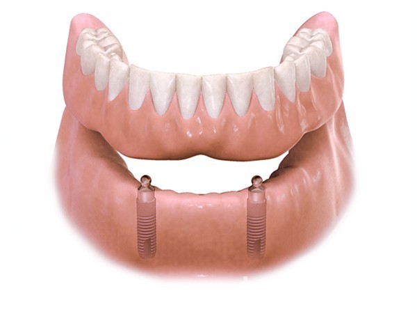 implant zęba cena bydgoszcz